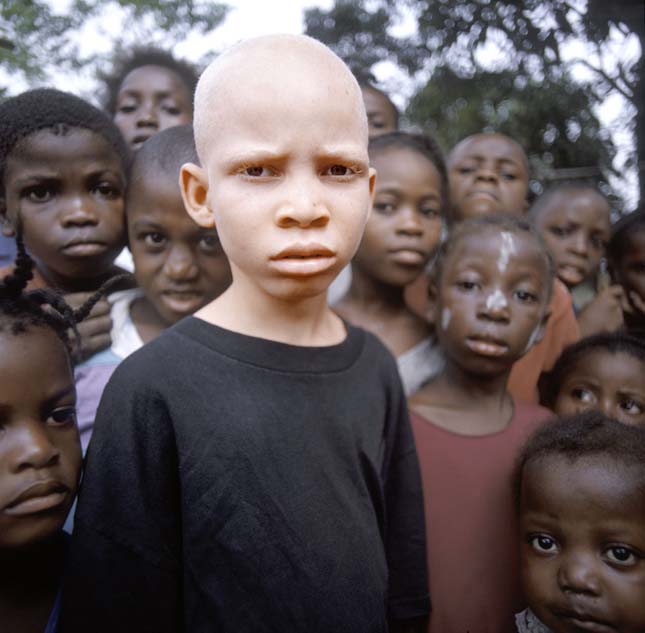Veszélyben vannak az afrikai albínók
