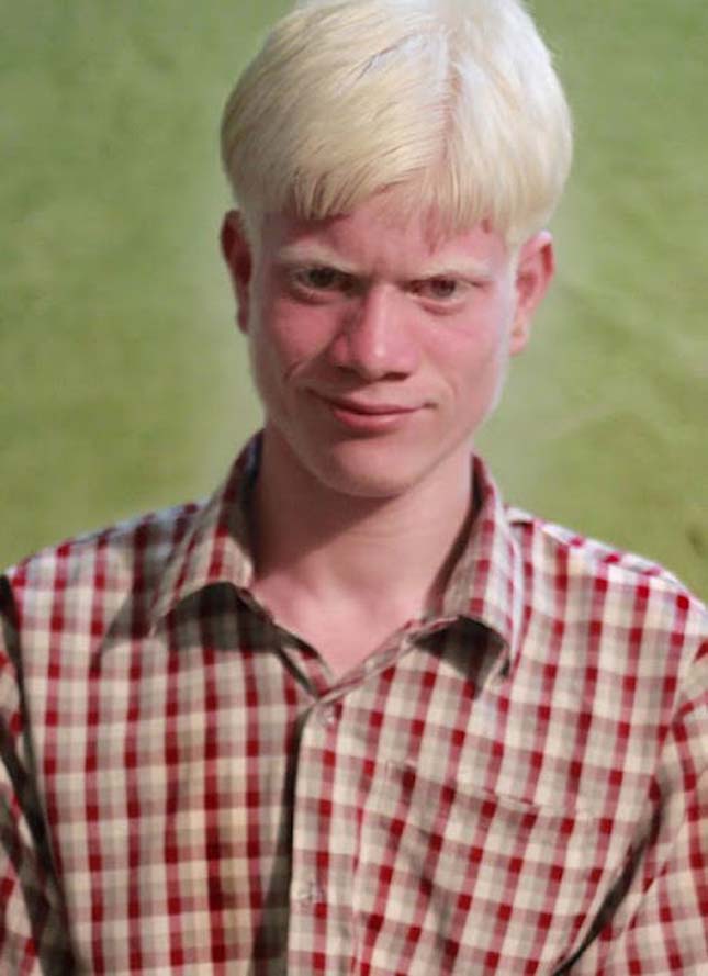 látvány emberek albínók hogy visszanyerje látását