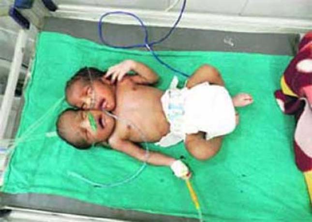 Kétfejű baba született Indiában