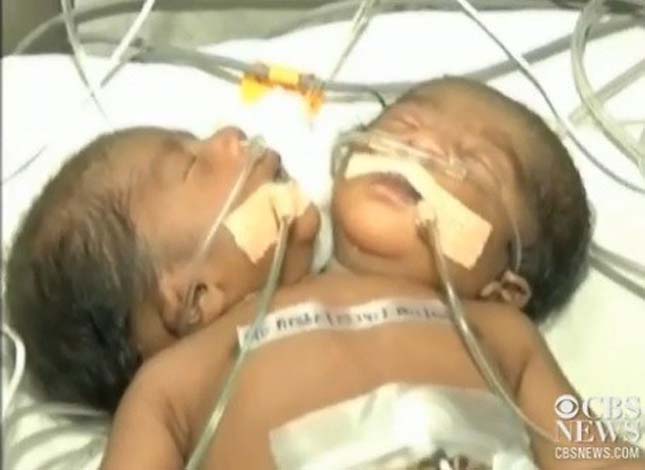 Kétfejű baba született Indiában