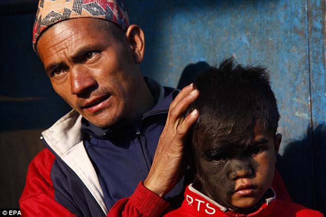 Szőrös arcú lány, Nepál