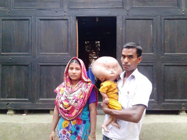 Vízfejűségben szenved egy bangladesi kisfiú